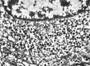 F,45y. | metastasis - carcinoid F,45y. | metastasis - carcinoid